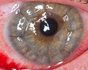 759px-A_human_eye_1_day_after_a_cornea_transplant